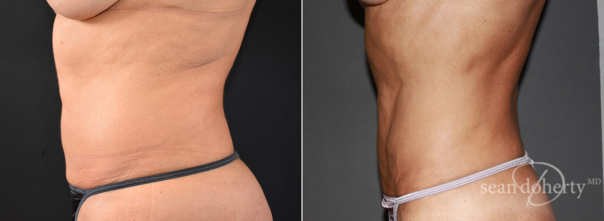 Liposuction Before and After Photos in Boston, MA, Patient 7797