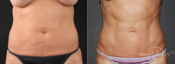 Liposuction Before and After Photos in Boston, MA, Patient 7797