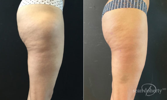 Liposuction Before and After Photos in Boston, MA, Patient 7798