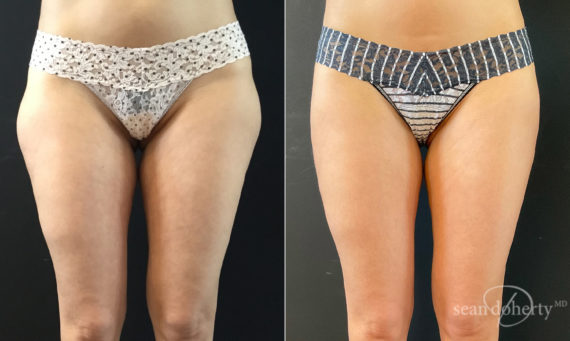 Liposuction Before and After Photos in Boston, MA, Patient 7798