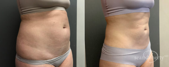 Liposuction Before and After Photos in Boston, MA, Patient 7799