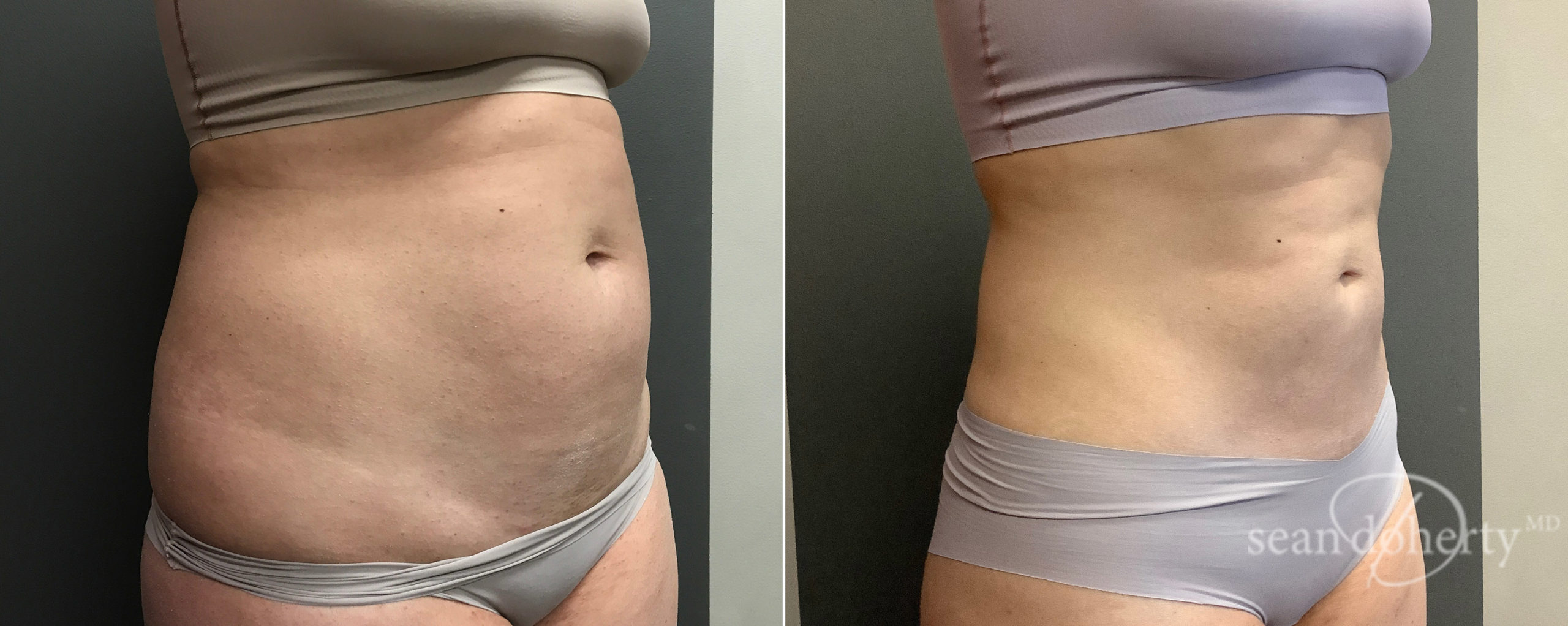 Liposuction Photos | Boston