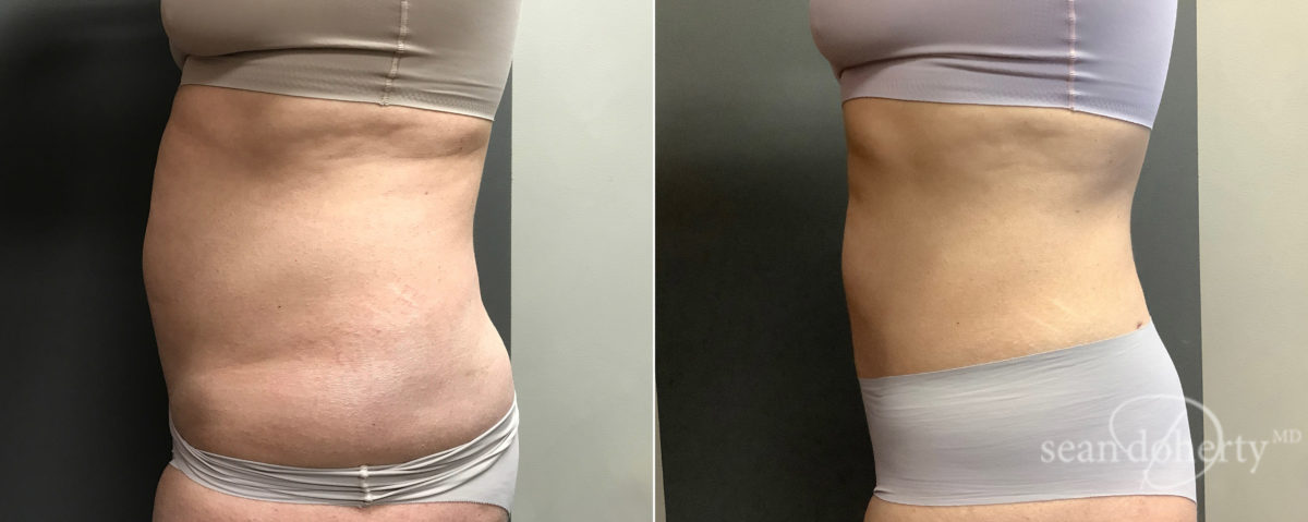 Liposuction Before and After Photos in Boston, MA, Patient 7799