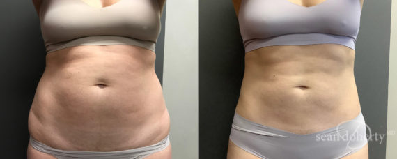 Liposuction Before and After Photos in Boston, MA, Patient 7799