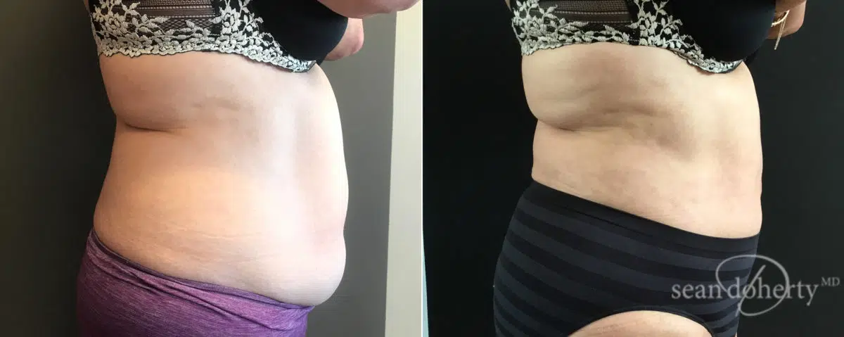 Liposuction Before and After Photos in Boston, MA, Patient 7800