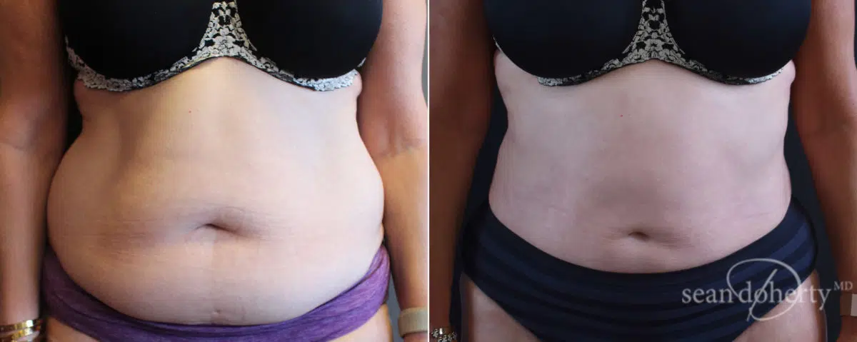 Liposuction Before and After Photos in Boston, MA, Patient 7800