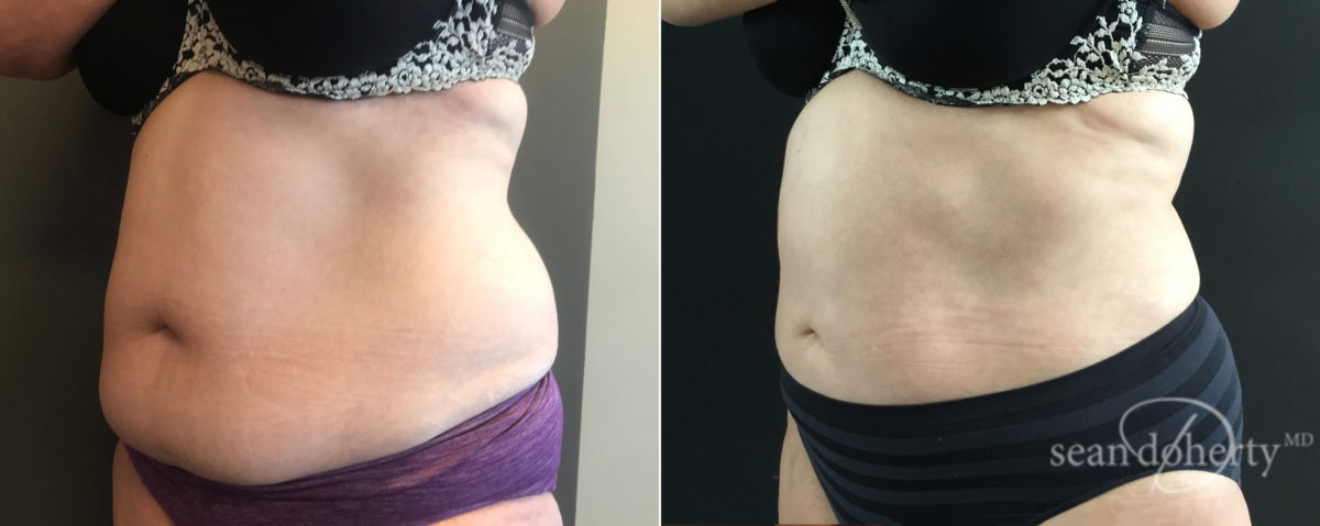 Liposuction Before and After Photos in Boston, MA, Patient 7800