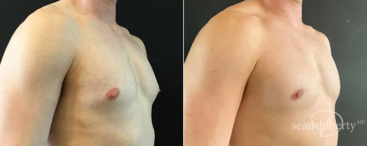 Gynecomastia Before and After Photos in Boston, MA, Patient 7840