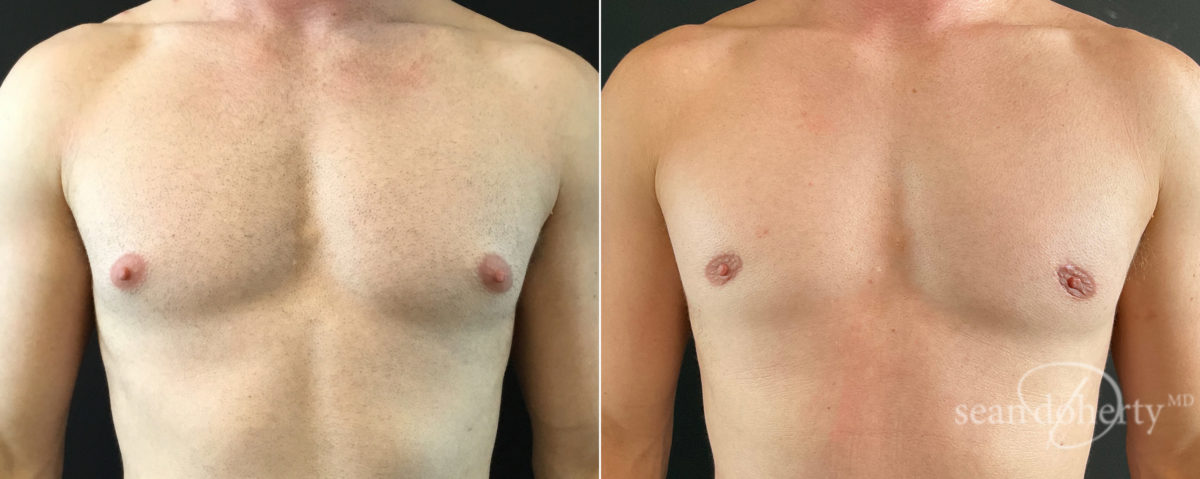 Patient 7840, Gynecomastia Before and After Photos Gynecomastia Before and After Photos in Boston, MA, Patient 7840