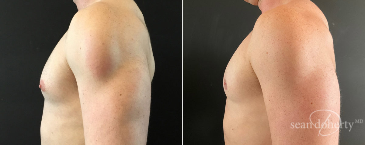 Gynecomastia Before and After Photos in Boston, MA, Patient 7840