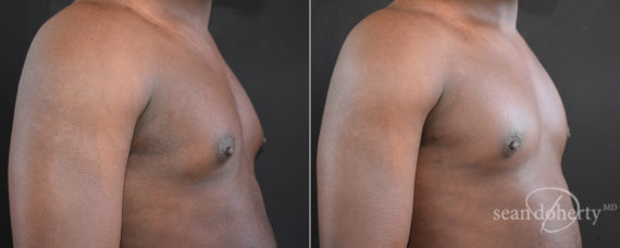 Gynecomastia Before and After Photos in Boston, MA, Patient 7841