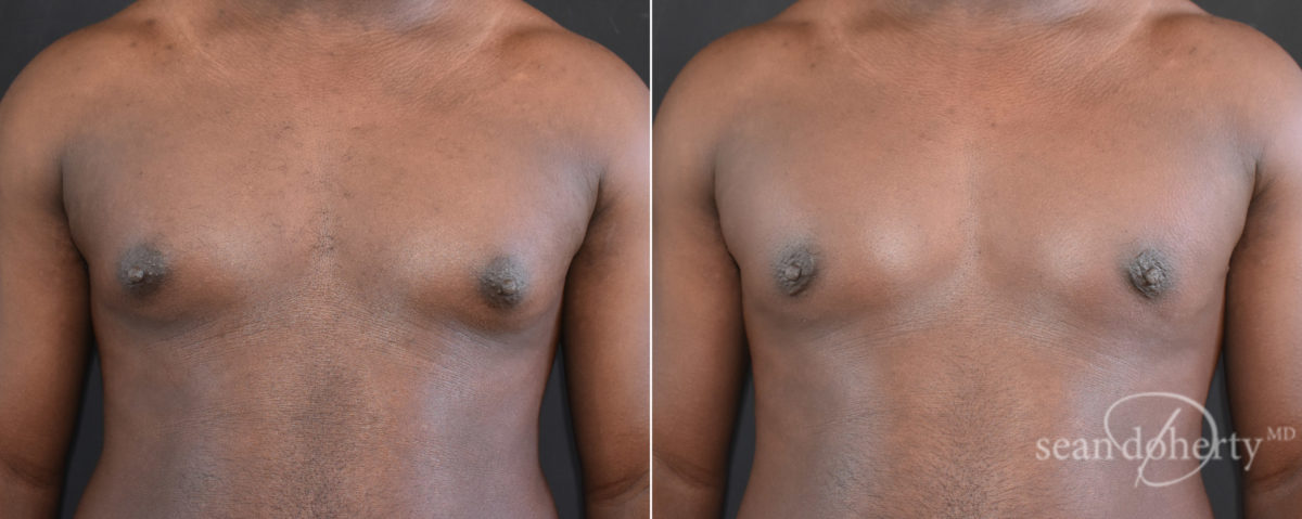 Gynecomastia Before and After Photos in Boston, MA, Patient 7841