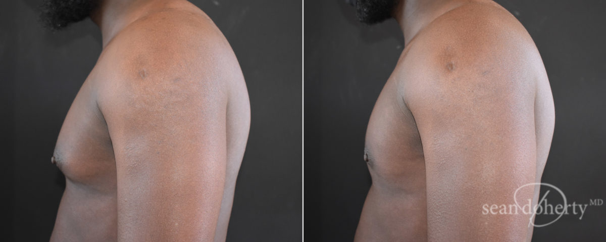 Gynecomastia Before and After Photos in Boston, MA, Patient 7841