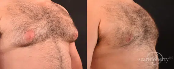 Gynecomastia Before and After Photos in Boston, MA, Patient 7860