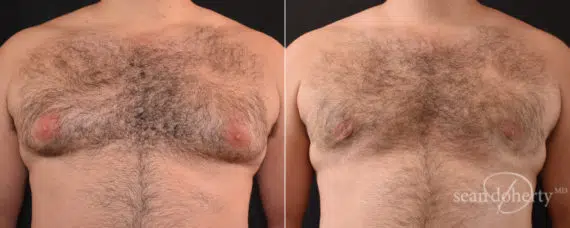 Gynecomastia Before and After Photos in Boston, MA, Patient 7860