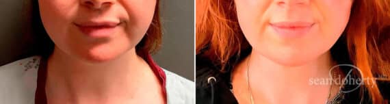 Neck Liposuction Before and After Photos in Boston, MA