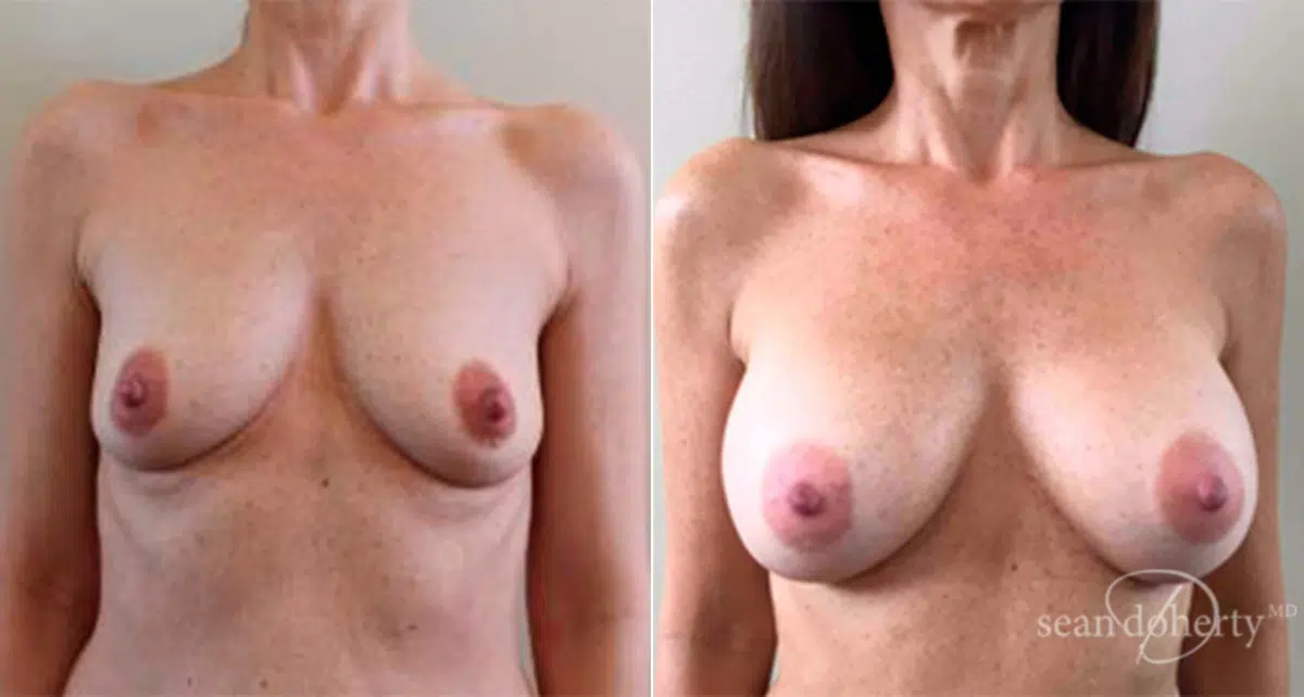 Patient 2410, Breast Augmentation Before and After Photos Breast Augmentation Before and After Photos in Boston, MA, Patient 2410