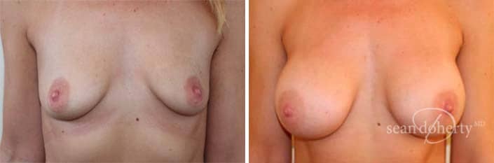 Breast Augmentation Before and After Photos in Boston, MA, Patient 3187