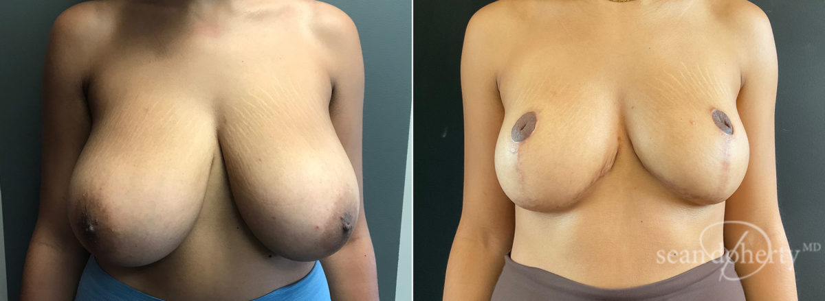 Breast Reduction Before and After Photos in Boston, MA, Patient 7756