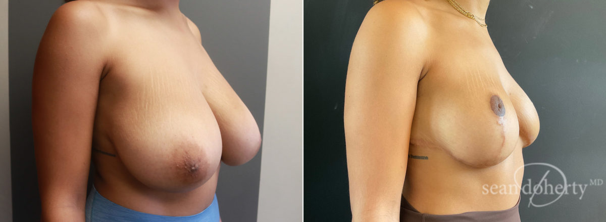 Breast Reduction Before and After Photos in Boston, MA, Patient 7756