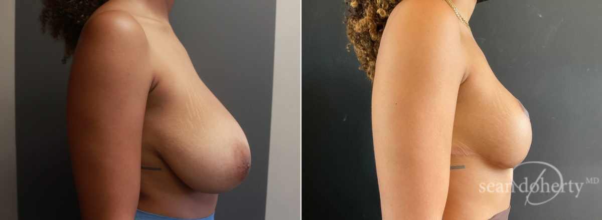 Breast Reduction Before and After Photos in Boston, MA, Patient 7756