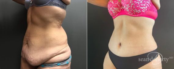 Tummy Tuck Before and After Photos in Boston, MA, Patient 8225