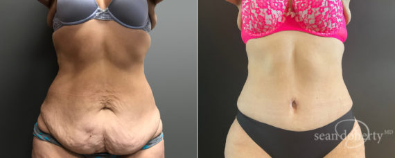 Tummy Tuck Before and After Photos in Boston, MA, Patient 8225