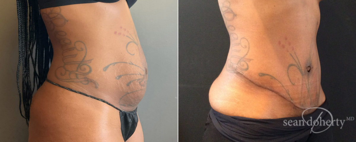 Tummy Tuck Before and After Photos in Boston, MA, Patient 8235