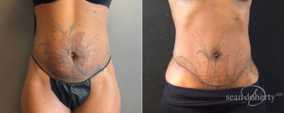 Tummy Tuck Before and After Photos in Boston, MA, Patient 8235