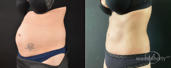 Tummy Tuck Before and After Photos in Boston, MA, Patient 8245