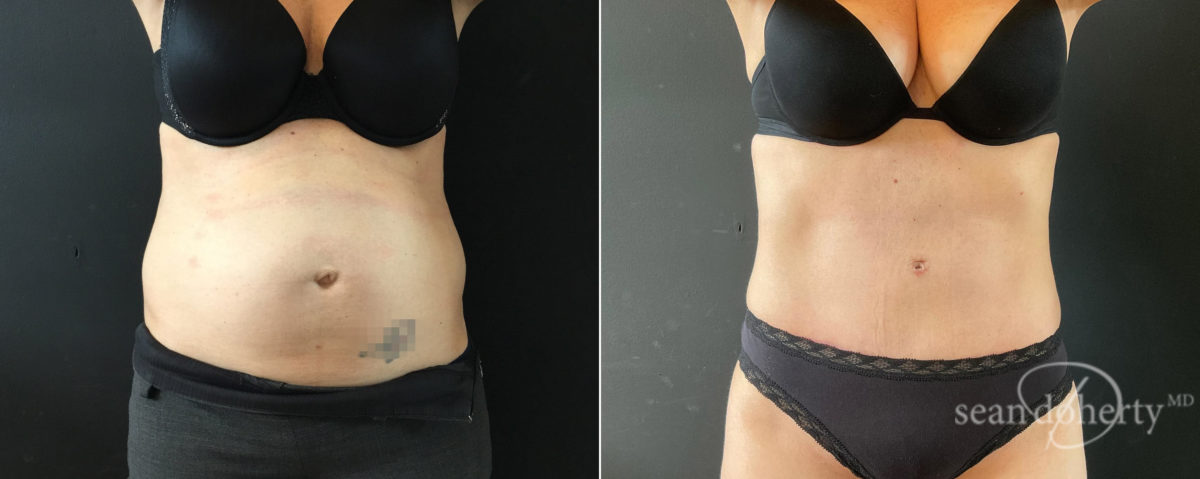 Tummy Tuck Before and After Photos in Boston, MA, Patient 8245