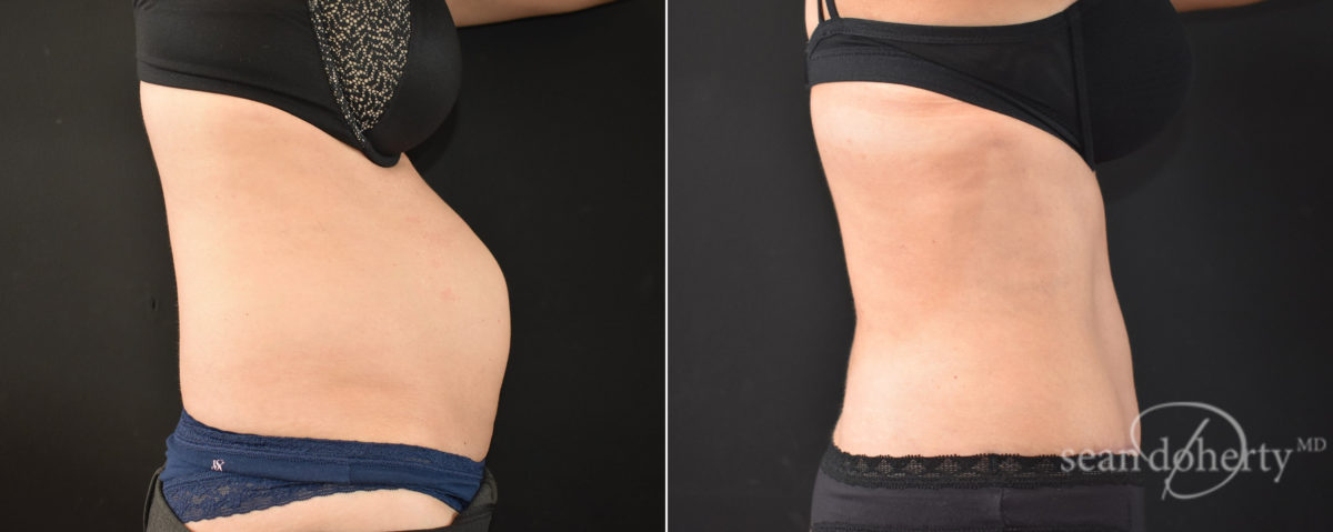 Tummy Tuck Before and After Photos in Boston, MA, Patient 8245