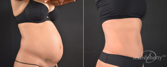 Tummy Tuck Before and After Photos in Boston, MA, Patient 8255