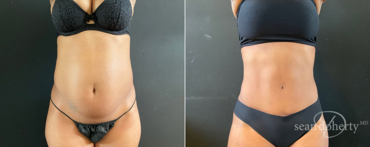 Tummy Tuck Before and After Photos in Boston, MA, Patient 8255