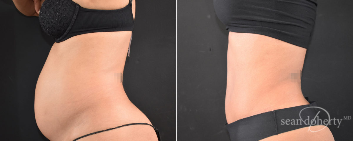 Tummy Tuck Before and After Photos in Boston, MA, Patient 8255