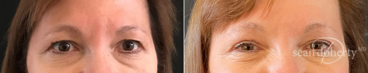 Patient 8262, Blepharoplasty Before and After Photos Blepharoplasty Before and After Photos in Boston, MA, Patient 8262