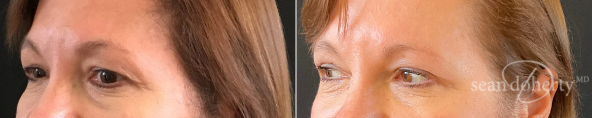 Patient 8262, Blepharoplasty Before and After Photos Blepharoplasty Before and After Photos in Boston, MA, Patient 8262
