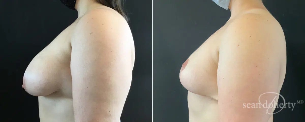 Breast Reduction Before and After Photos in Boston, MA, Patient 8273