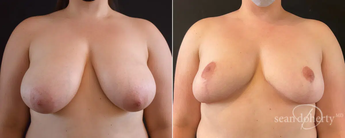 Breast Reduction Before and After Photos in Boston, MA, Patient 8273