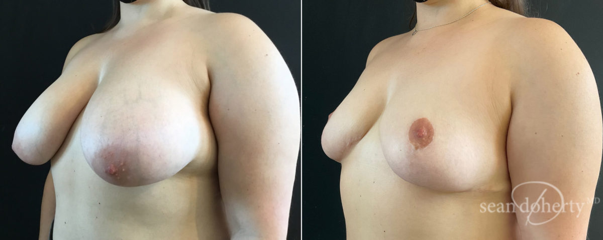 Breast Reduction Before and After Photos in Boston, MA, Patient 8273