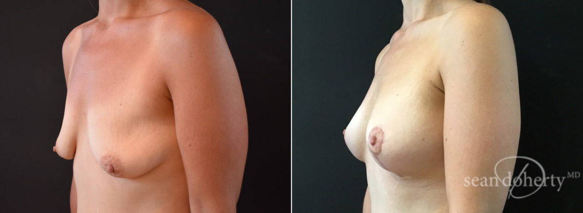 Patient 8288, Breast Lift with Implants Before and After Photos Breast Lift with Implants Before and After Photos in Boston, MA, Patient 8288