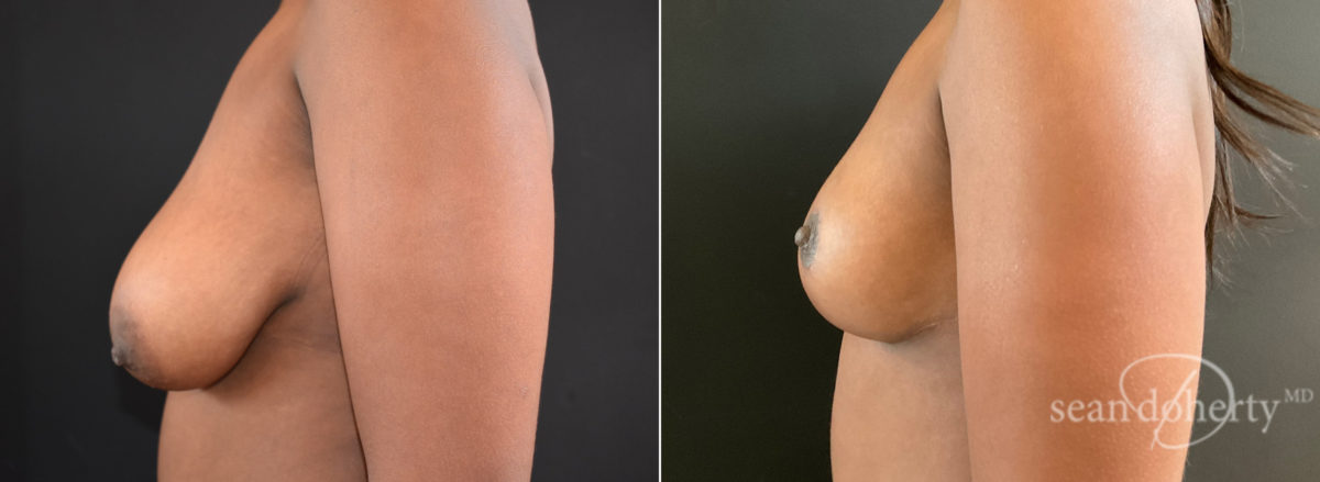 Patient 8329, Breast Lift Before and After Photos Breast Lift Before and After Photos in Boston, MA, Patient 8329
