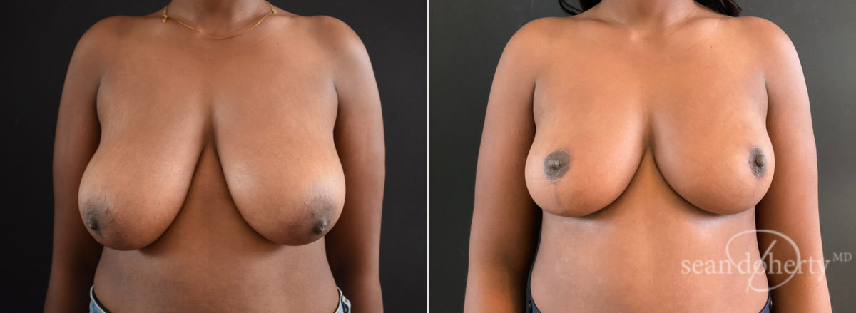 Patient 8329, Breast Lift Before and After Photos Breast Lift Before and After Photos in Boston, MA, Patient 8329