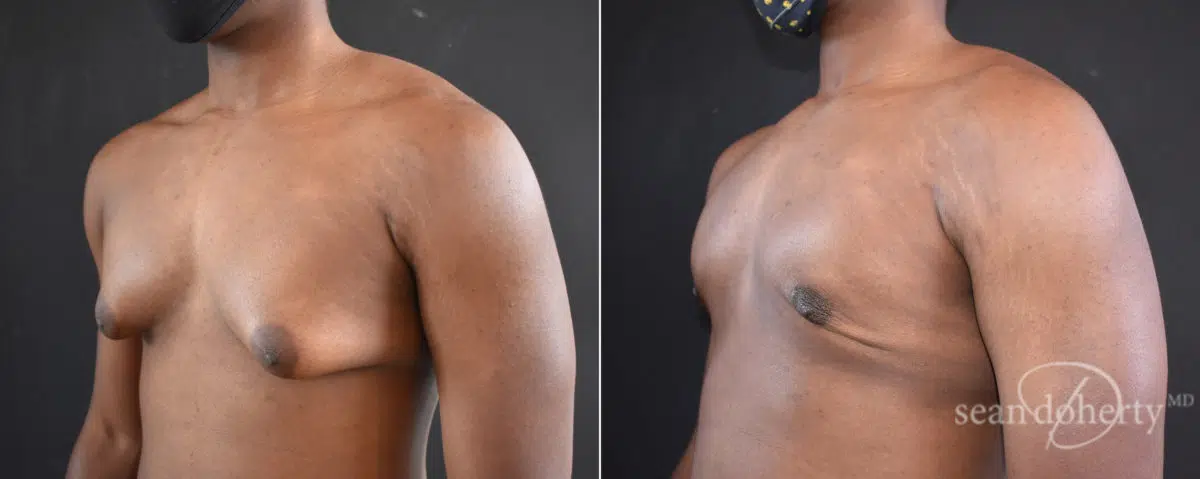 Gynecomastia Before and After Photos in Boston, MA, Patient 8351