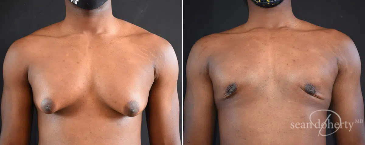 Gynecomastia Before and After Photos in Boston, MA, Patient 8351