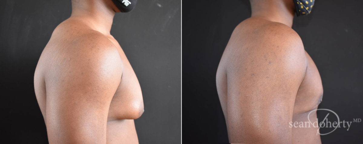 Gynecomastia Before and After Photos in Boston, MA, Patient 8351