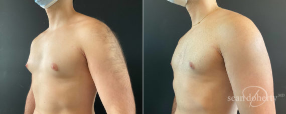 Gynecomastia Before and After Photos in Boston, MA, Patient 8362