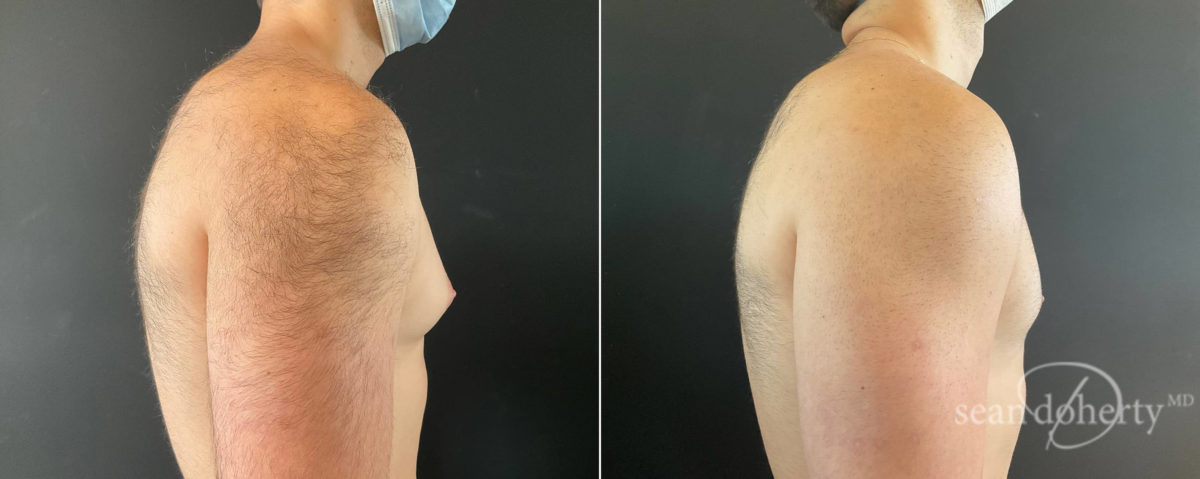 Patient 8362, Gynecomastia Before and After Photos Gynecomastia Before and After Photos in Boston, MA, Patient 8362