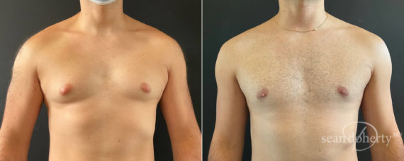 Gynecomastia Before and After Photos in Boston, MA, Patient 8362