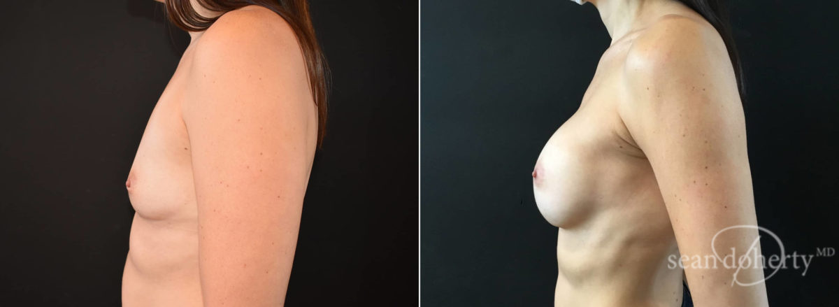 Breast Augmentation Before and After Photos in Boston, MA, Patient 8372